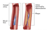 arteriosclerosis