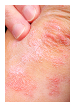 emotional cause of psoriasis