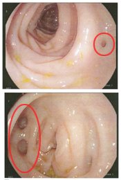 diverticulitis diverticulosis emotional cause